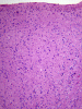 Focal cortical dysplasia, Palmini 1a, H&E stain