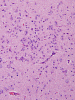 Focal cortical dysplasia, Palmini 1b, high power H&E stained section