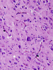 Focal cortical dysplasia, Palmini 2a, high power view of cerebral cortex