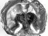 Holoprosencephaly, in situ photograph, coronal section through skull