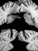 Sagittal sections through autopsy cerebellum, GM2 gangliosidosis (Tay Sachs disease).