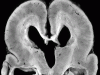 Lissencephaly, coronal section through brain.