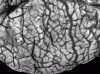 Polygyria, dorsal surface of brain