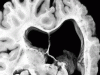 Polymicrogyria, coronal section through brain.