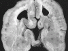 Subcortical band heterotopia, coronal section through brain