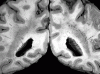 Zonal heterotopia, coronal sections through parietal lobes