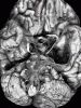 Temporal Lobe Arachnoid Cyst Ventral