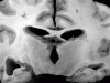 Necrosis of gray and white matter, coronal section