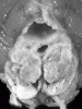 Leigh syndrome, transverse section through midbrain