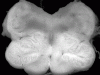 Medullary tegmental necrosis, transverse section of medulla