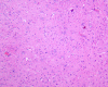 Cortical Tuber, low-power hematoxylin and eosin stained section