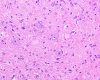 Cortical Tuber, medium-power hematoxylin and eosin stained section