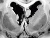 Tuberous Sclerosis, coronal section demonstrating numerous subependymal nodules and a subependymal giant cell tumor in the septum pellucidum