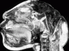 Anencephaly, sagittal section through cranium.