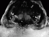 Anencephaly, dorsal view of  cranium