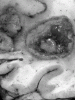 Brain abscess, coronal section of brain, close-up