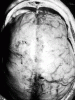 Subdural empyema, dorsal surface of brain, in situ photograph