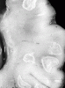 Neonatal cerebral candidiasis, coronal section, close-up.