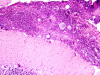 Acute meningitis secondary to Coccidioides, cerebellum, low power H&E stain.