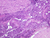 Cranial nerve inflammation secondary to coccidial meningitis, H&E stained section