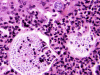 Coccidiodes meningitis, high-power H&E stain