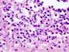 Cryptococcal meningitis, high-power H&E stained section.