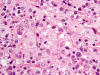 Histoplasmoma, H&E stained section, high-power.