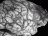 Phaeohyphomycosis, lateral surface of brain.