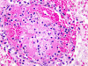 Phaeomycosis, high power H&E stained section