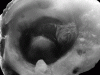 Cysticercosis, surgical specimen, hemisected, close-up