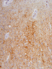 Sporadic Jakob-Creutzfeldt disease, occipital neocortex, 3F4 immunohistochemical staining x 200