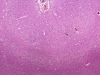 Sporadic Jakob-Creutzfeldt disease, occipital lobe neocortex, H&E stained x 40