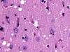 Sporadic Jakob-Creutzfeldt disease, stereotactic biopsy specimen, H&E stain x 400