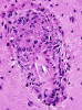 Perivascular granulomatous inflammation in a patient with neurosarcoidosis