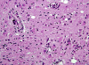 HIV encephalopathy, H&E stained section