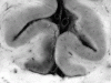 Herpes simplex encephalitis, coronal section through cingulate gyri, close-up.