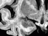 Herpes simplex encephalitis, coronal section through temporal lobe and basal ganglia.