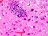 Progressive multifocal leukoencephalopathy, H&E stained section x 200