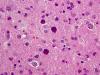 Progressive multifocal leukoencephalopathy, H&E stain section x 200