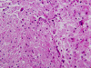 Progressive multifocal leukoencephalopathy, H&E stained section x 100