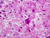 Progressive multifocal leukoencephalopathy, H&E stain x 400