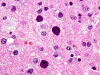 Progressive Multifocal Leukoencephalopathy H&E