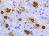 Progressive multifocal leukoencephalopathy, JC virus immunohistochemical staining