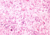 West nile virus myelitis, H&E stained section