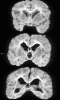 Cockayne syndrome, multiple coronal sections of brain