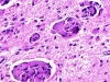 Krabbe disease, H&E stained section, high power