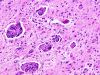 Krabbe disease, H&E stain x 100