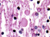 Vanishing White matter disease, H&E stain, high power