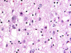 Vanishing White matter disease, thalamus, H&E stain section