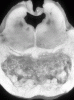 Central Pontine Myelinolysis, transverse section